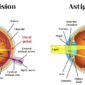 Lasik Eye Surgery