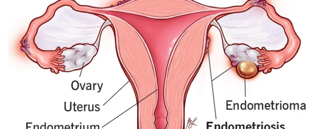 Treatments For Endometriosis