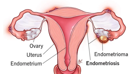 Treatments For Endometriosis